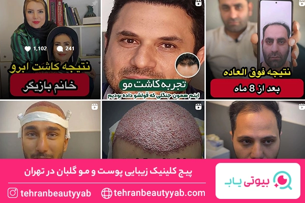 بهترین کلینیک کاشت ابرو در تهران