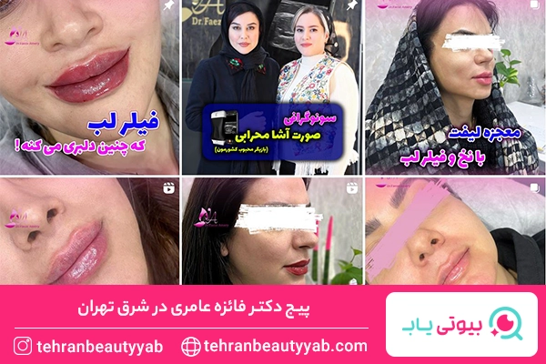 تزریق ژل لب در شرق تهران