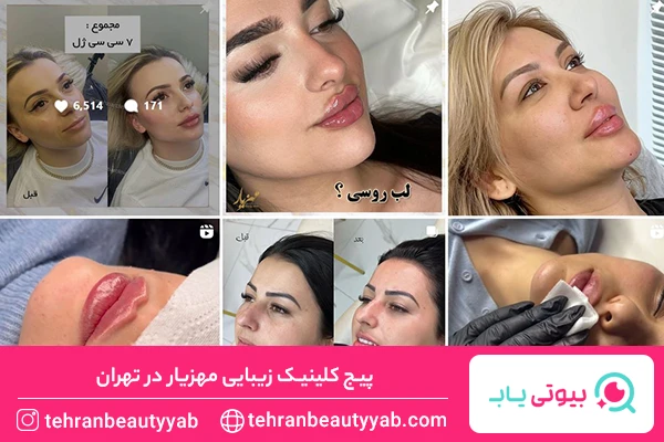 بهترین مرکز بوتاکس در تهران