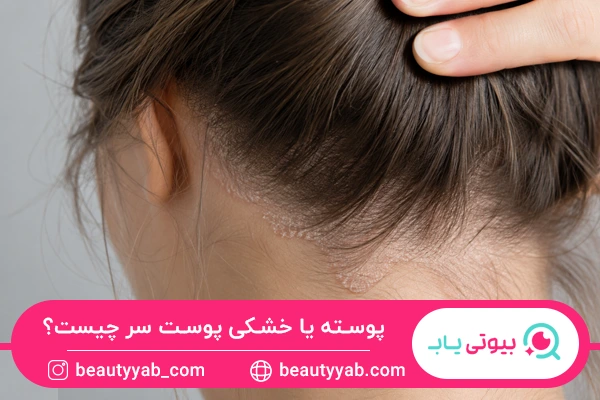 پوسته یا خشکی پوست سر
