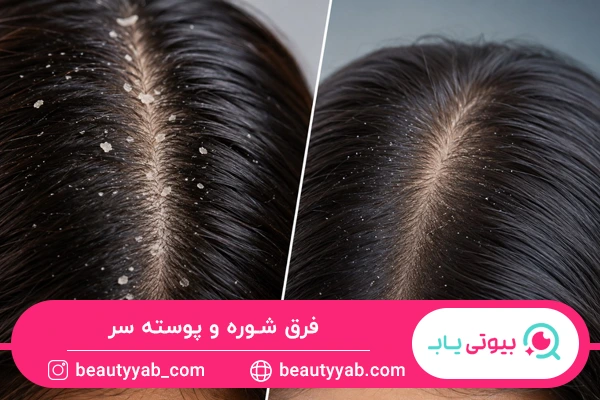 فرق شوره و پوسته سر