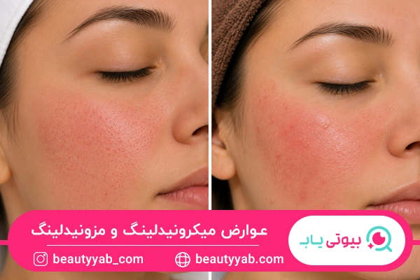 تفاوت عوارض میکرونیدلینگ و مزونیدلینگ