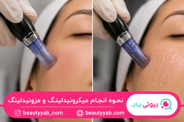 تفاوت در روش انجام میکرونیدلینگ و مزونیدلینگ