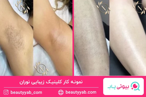کلینیک زیبایی نوران؛ بهترین مرکز لیزر در صادقیه