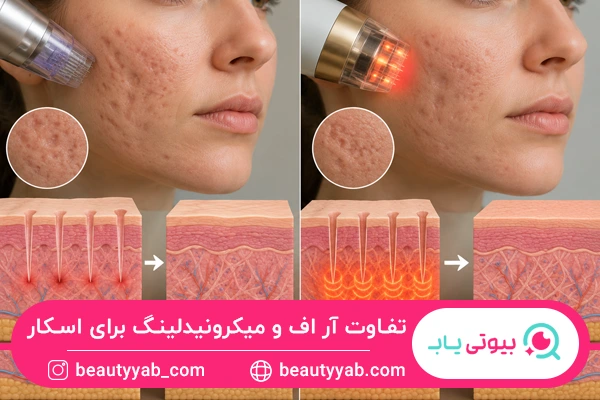 تفاوت آر اف فرکشنال و میکرونیدلینگ برای اسکار و جای جوش