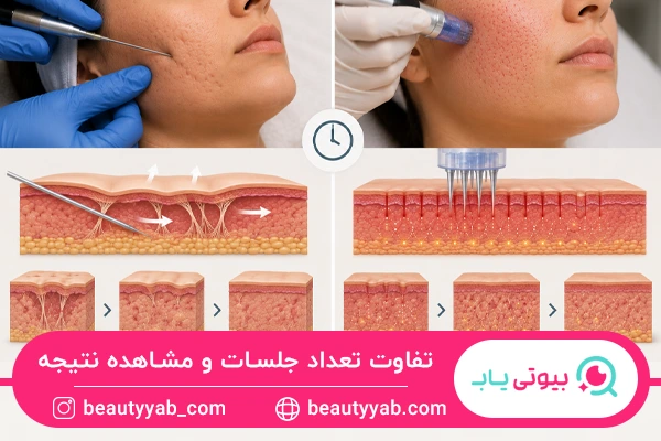 تفاوت تعداد جلسات سابسیژن و میکرونیدلینگ