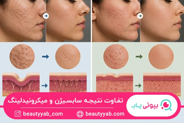 تفاوت نتیجه سابسیژن و میکرونیدلینگ روی بافت پوست