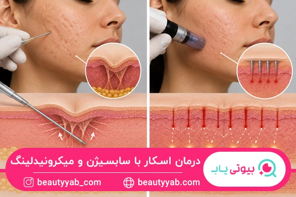 تفاوت نحوه درمان اسکار در سابسیژن و میکرونیدلینگ