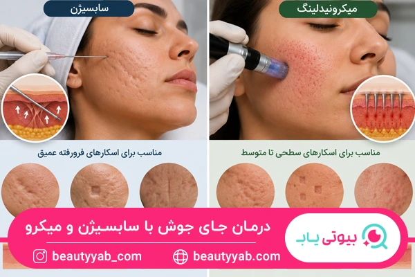 درمان جای جوش با سابسیژن و میکرو