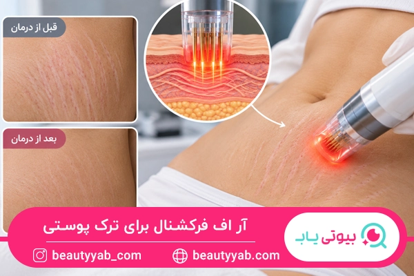 آر اف فرکشنال برای ترک پوستی