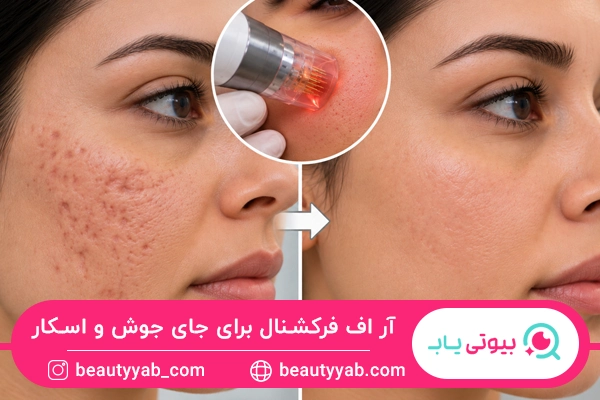 آر اف فرکشنال برای جای جوش و اسکار