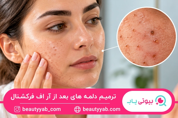 ترمیم دلمه های بعد از آر اف فرکشنال