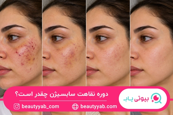 دوره نقاهت سابسیژن
