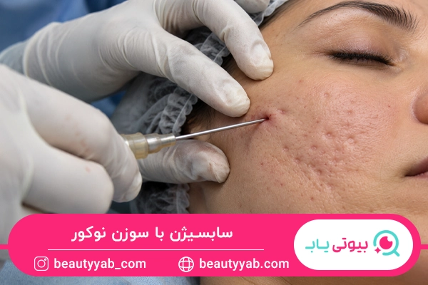 سابسیژن با سوزن نوکور