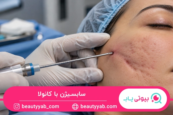 سابسیژن با کانولا