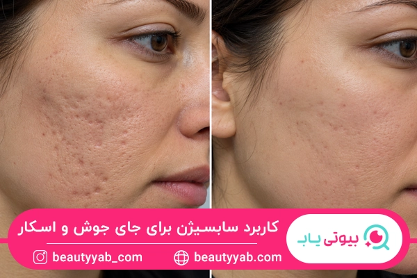 کاربرد سابسیژن برای جای جوش